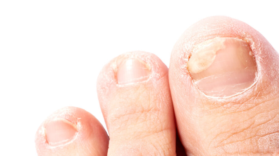 Ciclopoli Nagelpilztherapie Empfehlung einer topischen Monotherapie 1
