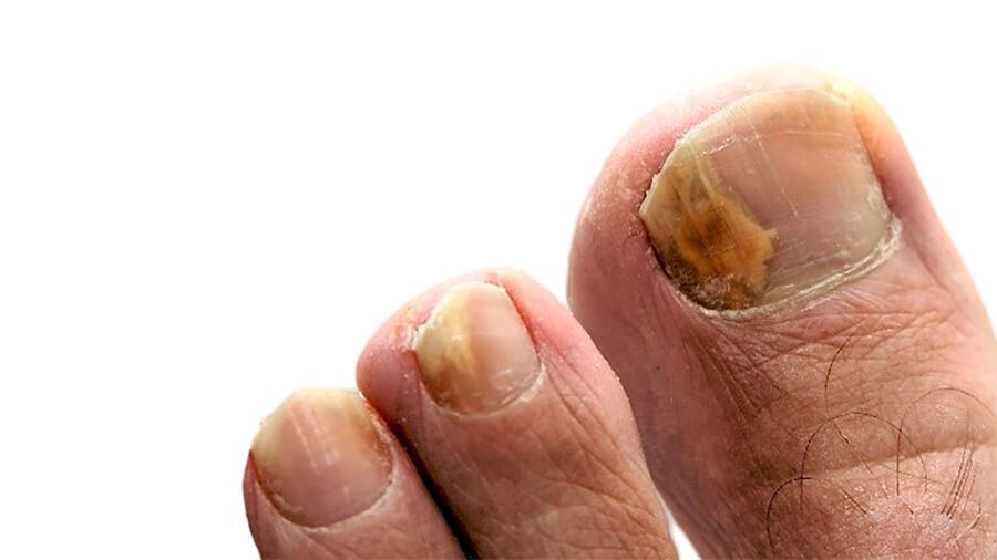 Ciclopoli Nagelpilztherapie Empfehlung einer topischen Monotherapie 2