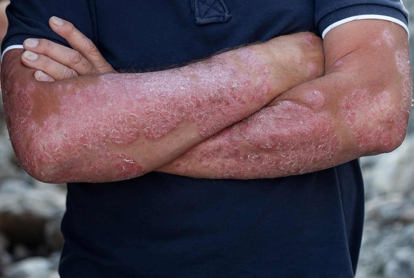 Psoriasis Arme