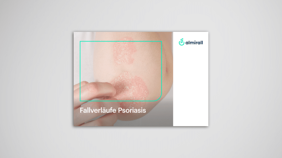 Topische Psoriasis Fallverlaeufe