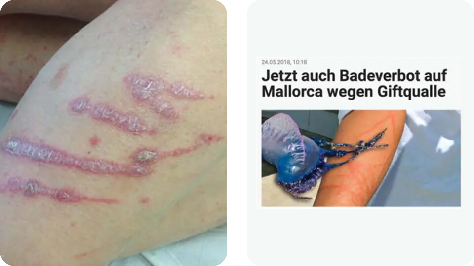 Psoriasis Volkskrankheit Suppenflechte 1