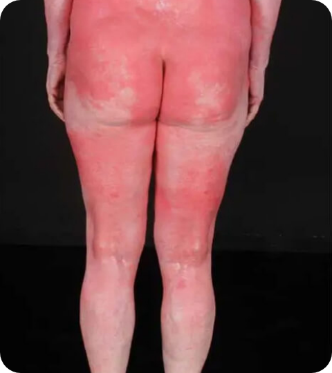 Psoriasis Volkskrankheit Suppenflechte 10