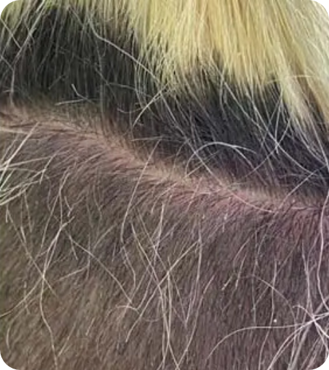Psoriasis Volkskrankheit Suppenflechte 12