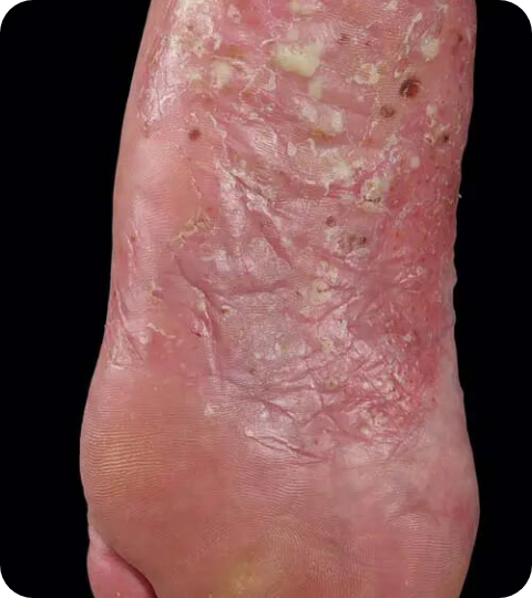 Psoriasis Volkskrankheit Suppenflechte 13