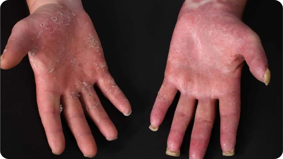 Psoriasis Volkskrankheit Suppenflechte 14