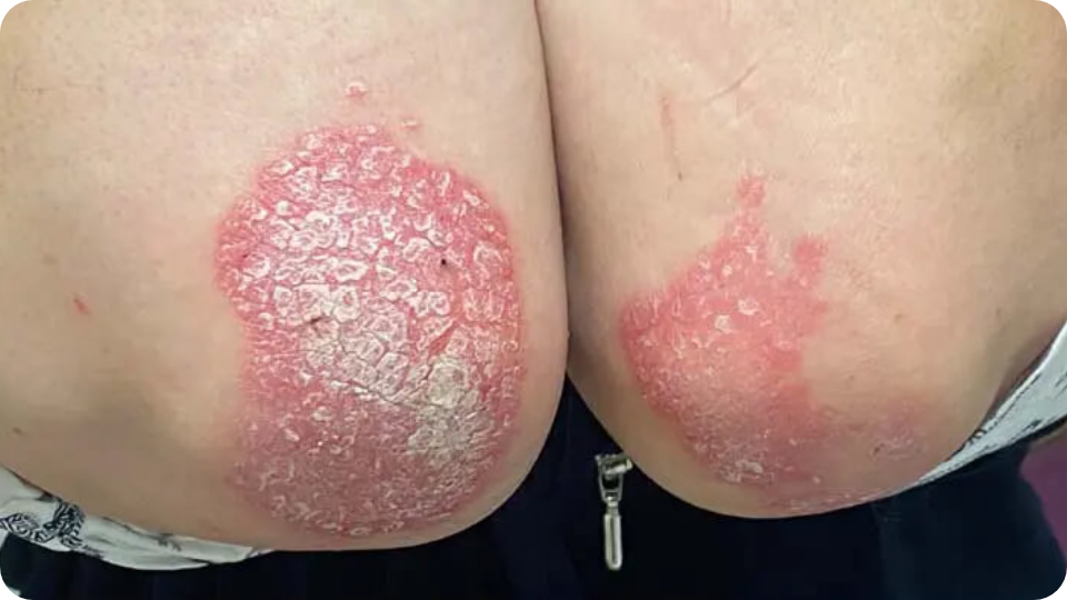 Psoriasis Volkskrankheit Suppenflechte 16