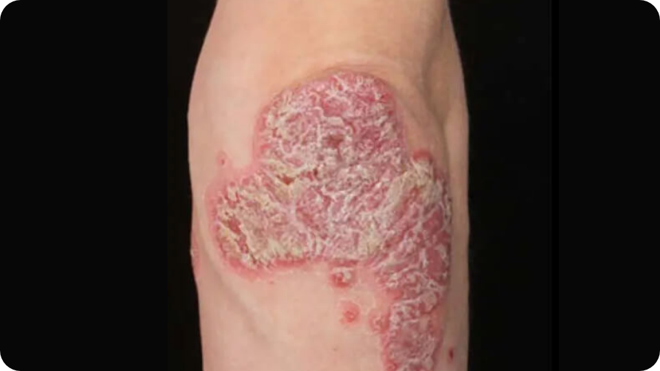 Psoriasis Volkskrankheit Suppenflechte 17