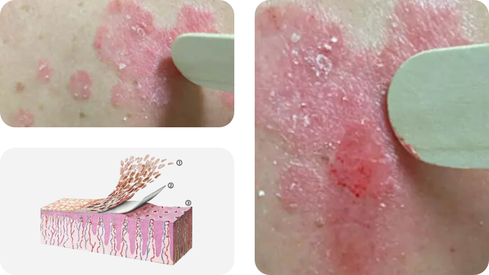 Psoriasis Volkskrankheit Suppenflechte 18