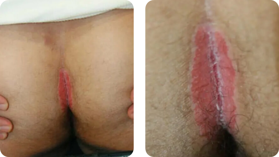 Psoriasis Volkskrankheit Suppenflechte 2