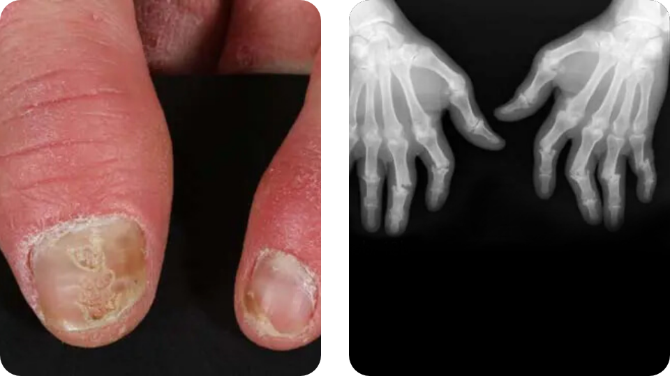 Psoriasis Volkskrankheit Suppenflechte 3