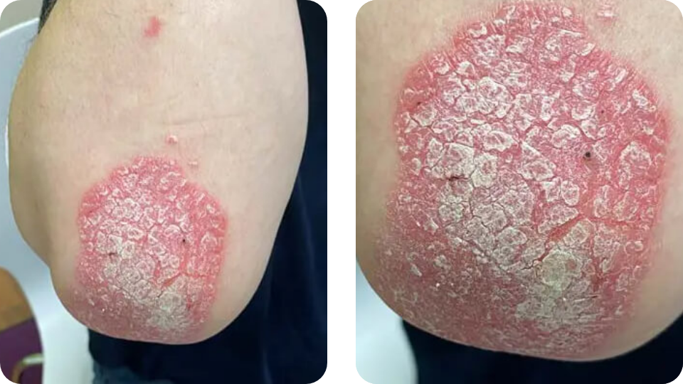 Psoriasis Volkskrankheit Suppenflechte 4