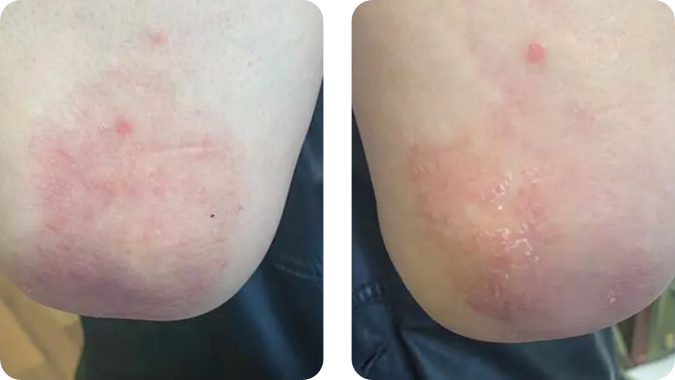 Psoriasis Volkskrankheit Suppenflechte 5