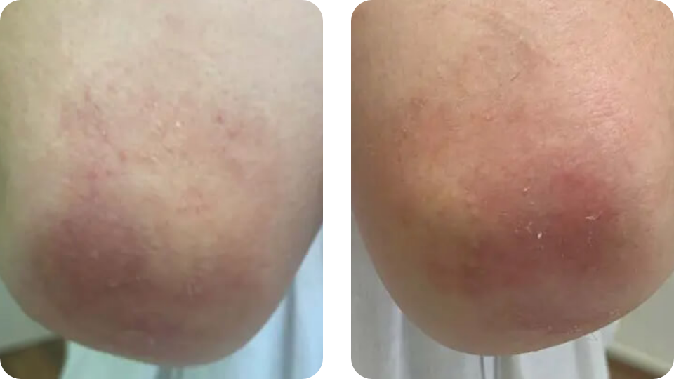 Psoriasis Volkskrankheit Suppenflechte 6