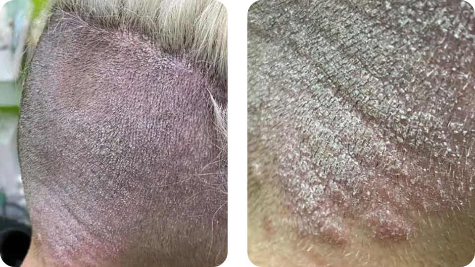 Psoriasis Volkskrankheit Suppenflechte 7