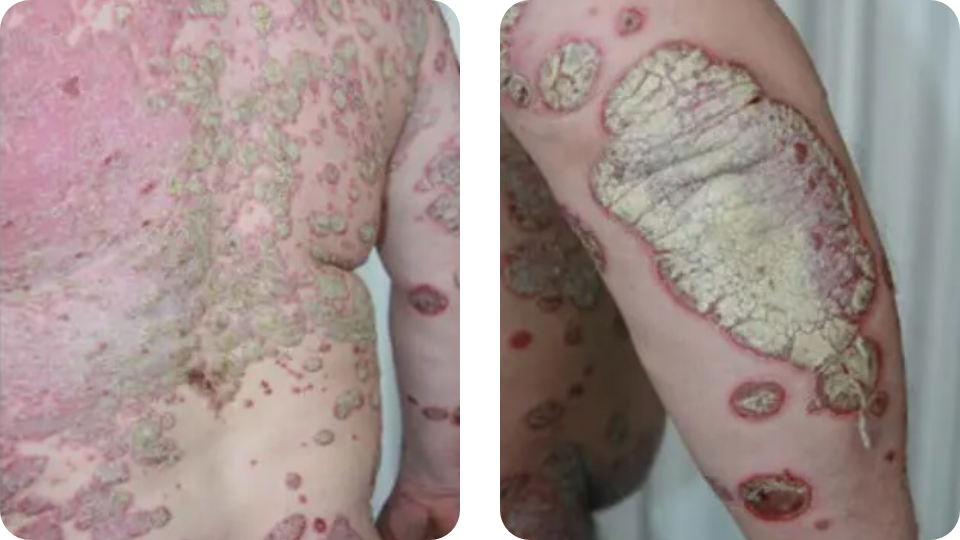 Psoriasis Volkskrankheit Suppenflechte 8