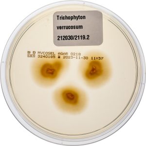 Dermatomykosen und infizierte Ekzeme Dermatophyten