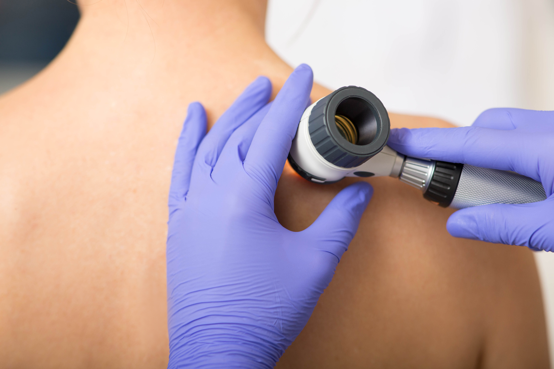 Aktinische keratosen ursache diagnose behandlung therapie bild 1