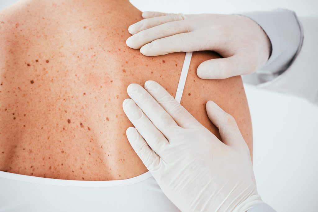 Aktinische keratosen ursache diagnose behandlung therapie bild 2