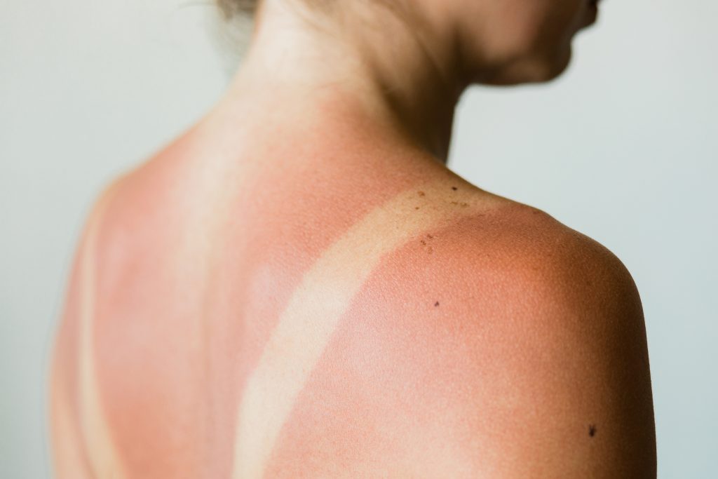 Aktinische keratosen ursache diagnose behandlung therapie bild 3