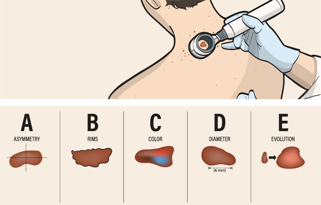 Aktinische keratosen ursache diagnose behandlung therapie bild 4