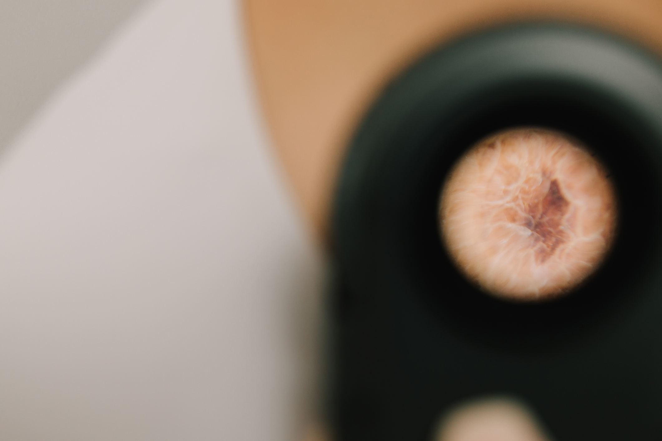 Aktinische keratosen ursache diagnose behandlung therapie bild 9