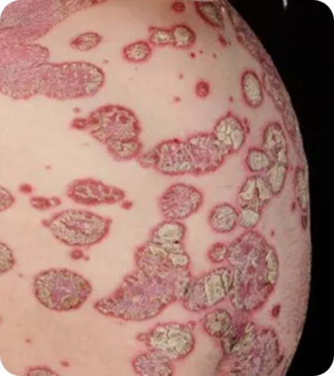 Psoriasis Volkskrankheit Suppenflechte 11 CLOSE