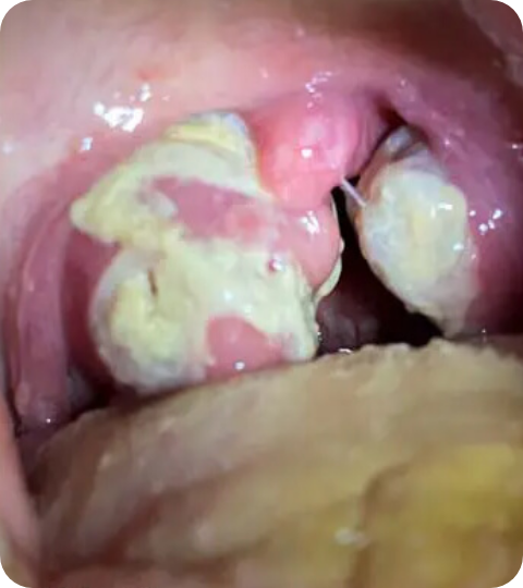 Psoriasis Volkskrankheit Suppenflechte 9