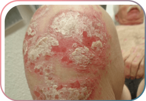 Plaque-Psoriasis