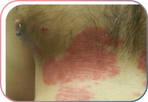 Psoriasis auf behaarten Arealen