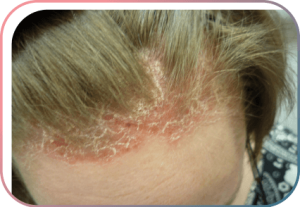 Psoriasis auf dem behaarten Kopf