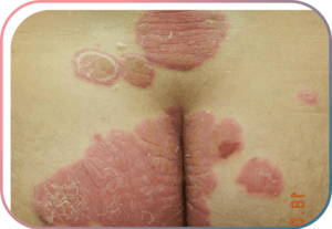 Psoriasis – spezielle Lokalisationen